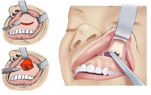 Гайморотомия