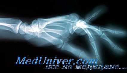 ревматоидный артрит