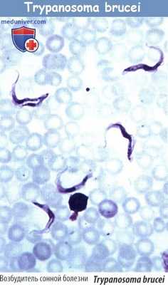 Сонная болезнь - трипаносомоз