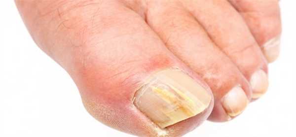 Причины возникновения грибка ногтей