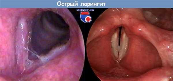 Острый ларингит