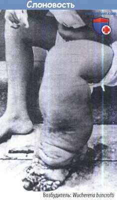 Слоновость - филяриатоз