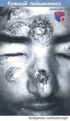 Кожный лейшманиоз