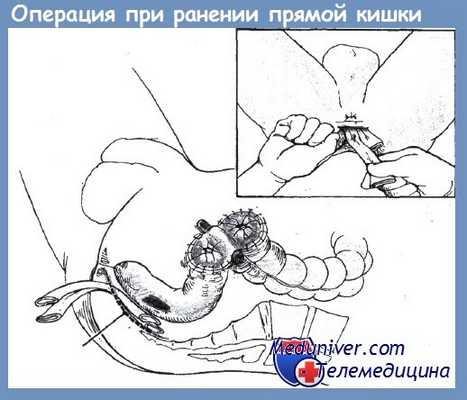 операция при ранении прямой кишки