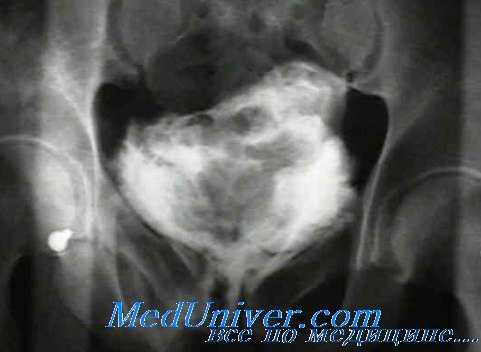Контрастное исследование при травме прямой кишки