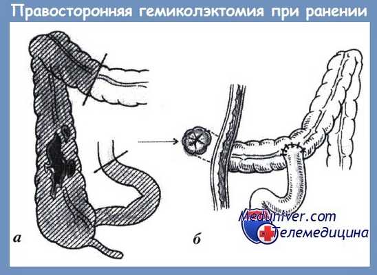 резекция толстой кишки при ранении