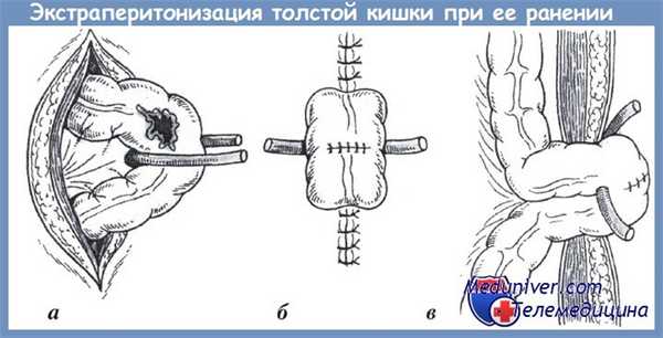экстраперитонизация толстой кишки при ранении