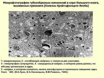 Микрофото при прионной болезни