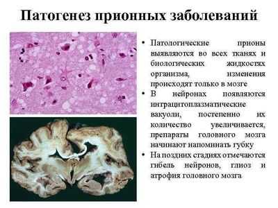 Патогенез прионных заболеваний
