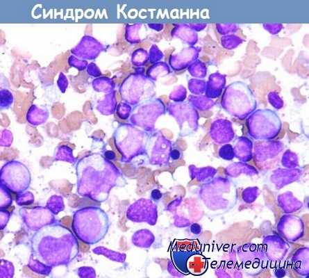 Синдром Костманна - наследственный детский агранулоцитоз