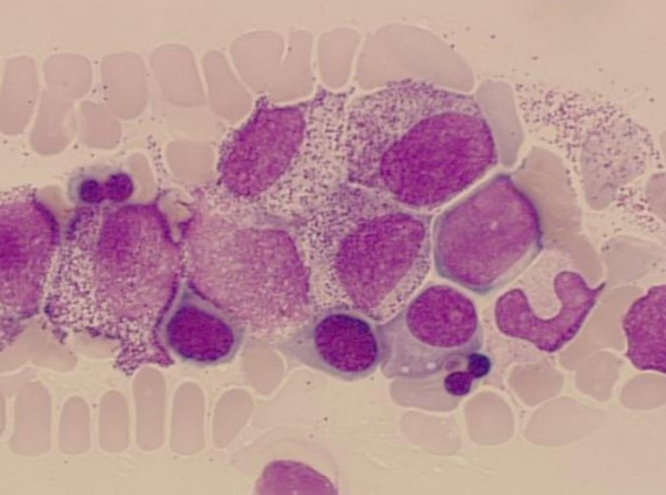 Агранулоцитоз