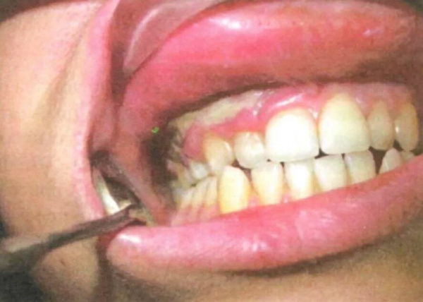 Некротические изменения тканей полости рта при агранулоцитозе