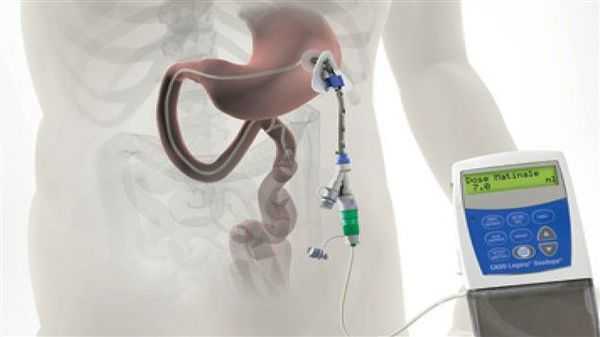 Лекарственный паркинсонизм