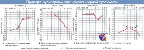 Примеры аудиограмм при нейросенсорной тугоухости