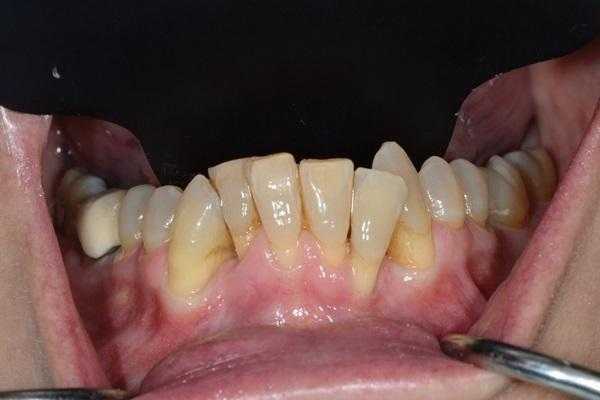 Прогностичность аугментации вестибулярной костной пластинки при комплексном ортодонтическом лечении