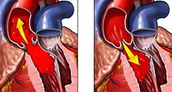 Аортальная недостаточность