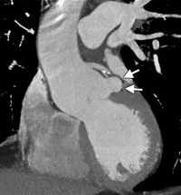 Малые аномалии развития сердца