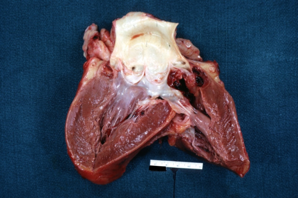 Малые аномалии развития сердца