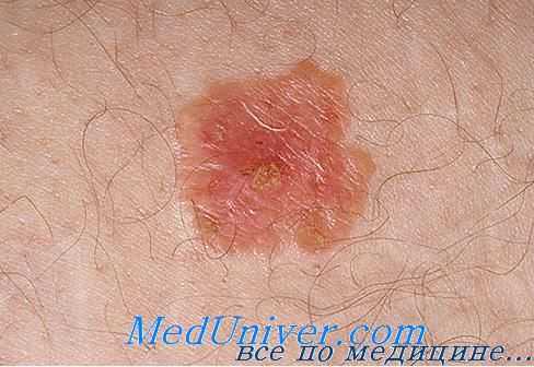 лейкоплакия полости рта