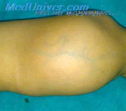 опухоли мышечной ткани