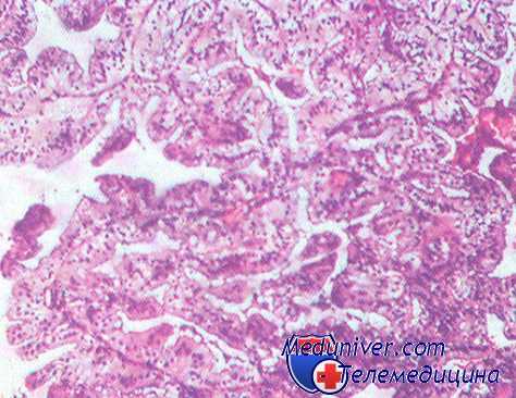 лейомиома из сосудов