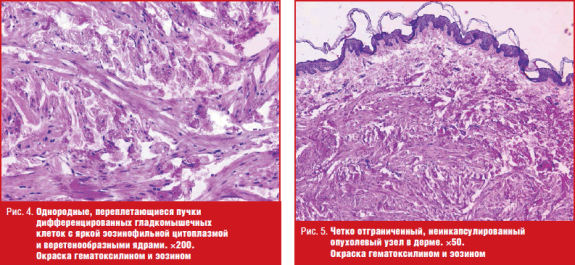 Четко отграниченный, неинкапсулированный опухолевый узел в дерме.