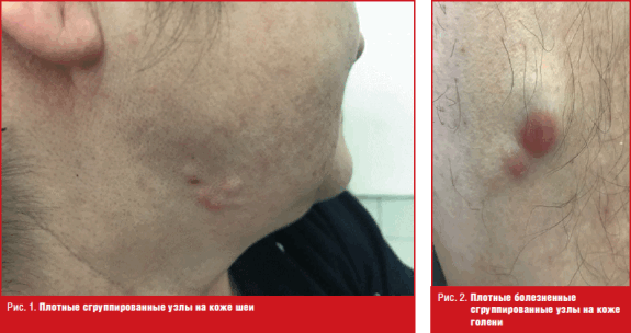 Плотные сгруппированные узлы на коже шеи