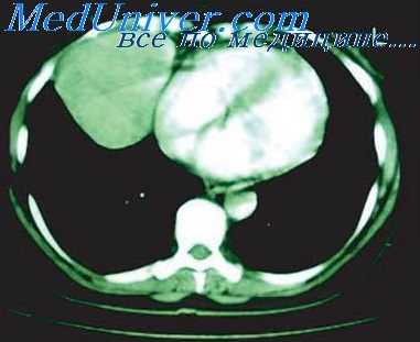 лимфангиома средостения