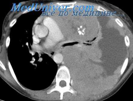 доброкачественные тимомы