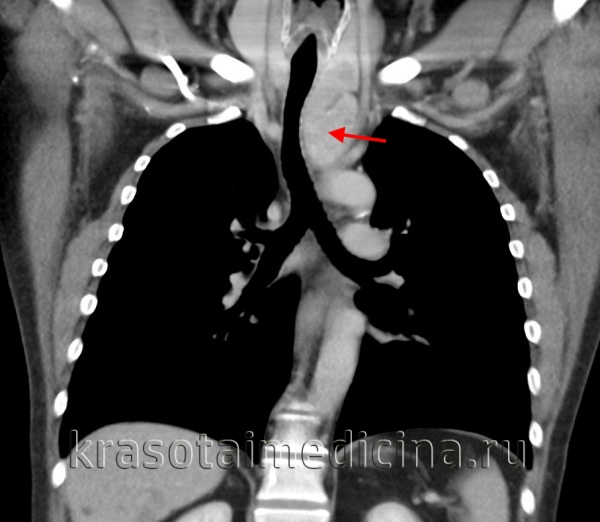 Лимфангиома