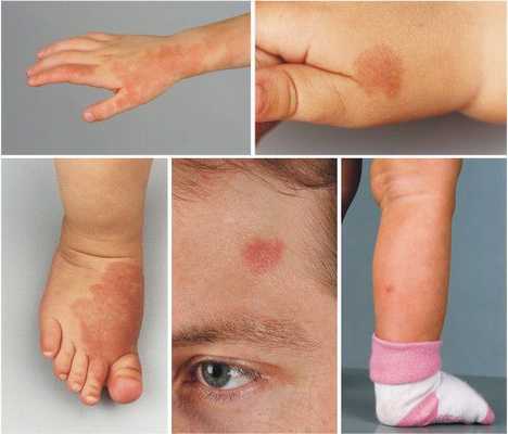 Варианты локализации капиллярной мальформации