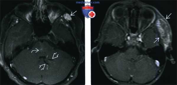 КТ, МРТ венозной мальформации головы и шеи
