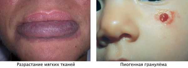 Разрастание мягких тканей и пиогенная гранулёма