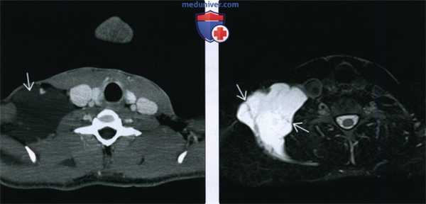 КТ, МРТ при лимфатической мальформации головы и шеи