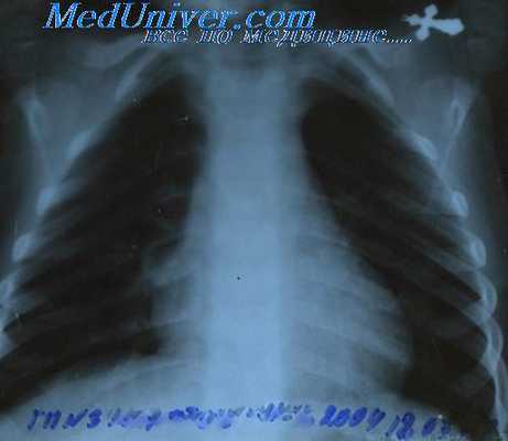 лимфогранулематоз годжкина