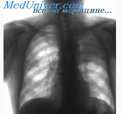 лимфогранулематоз