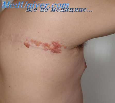 парагранулема годжкина