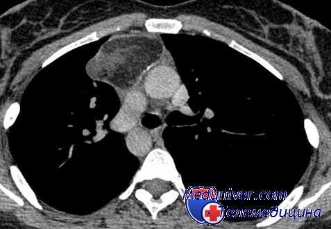 лимфогранулематоз