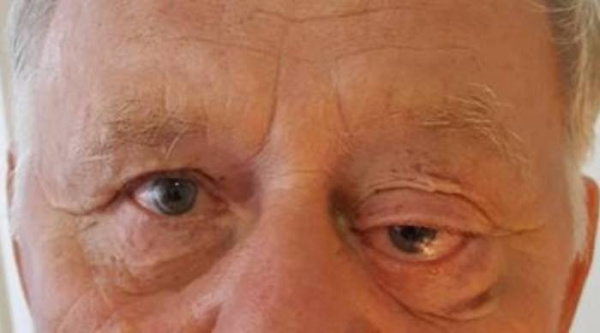 Лимфома Беркитта