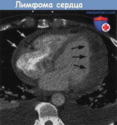 Лимфома сердца