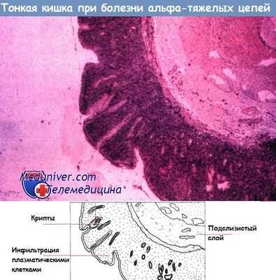 Тонкая кишка при болезни альфа тяжелых цепей