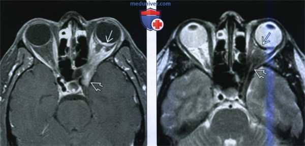 КТ, МРТ при меланоме глаза
