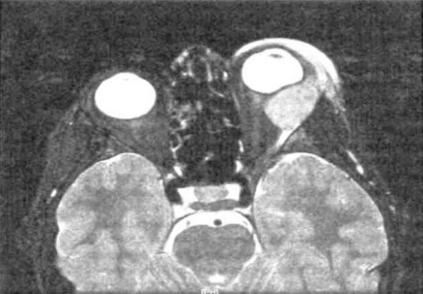 МРТ при лимфоме орбиты