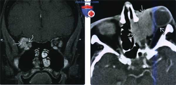 КТ, МРТ при лимфопролиферативном образовании глазницы
