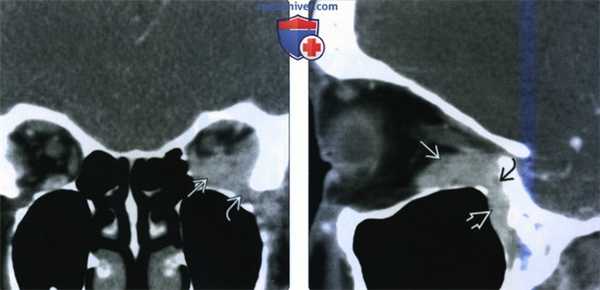 КТ, МРТ при лимфопролиферативном образовании глазницы
