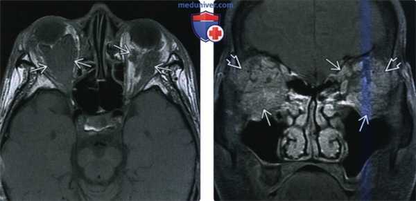 КТ, МРТ при лимфопролиферативном образовании глазницы