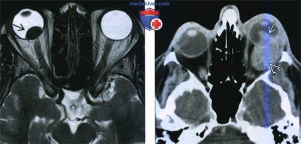 КТ, МРТ при меланоме глаза