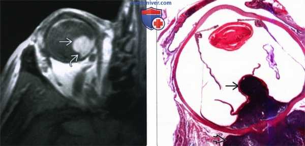 КТ, МРТ при меланоме глаза