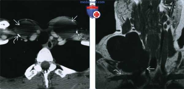 Лимфоцеле шеи - лучевая диагностика