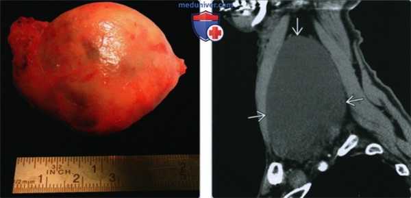 Лимфоцеле шеи - лучевая диагностика